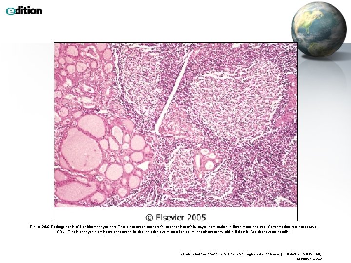 Figure 24 -9 Pathogenesis of Hashimoto thyroiditis. Three proposed models for mechanism of thyrocyte