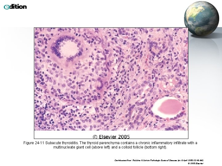 Figure 24 -11 Subacute thyroiditis. The thyroid parenchyma contains a chronic inflammatory infiltrate with