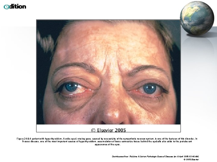 Figure 24 -8 A patient with hyperthyroidism. A wide-eyed, staring gaze, caused by overactivity