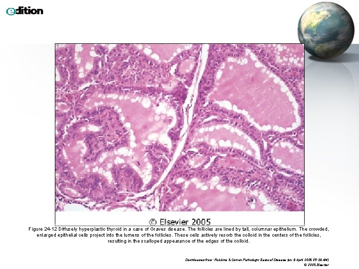 Figure 24 -12 Diffusely hyperplastic thyroid in a case of Graves disease. The follicles