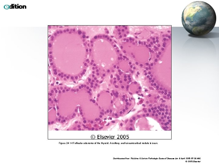 Figure 24 -14 Follicular adenoma of the thyroid. A solitary, well-circumscribed nodule is seen.