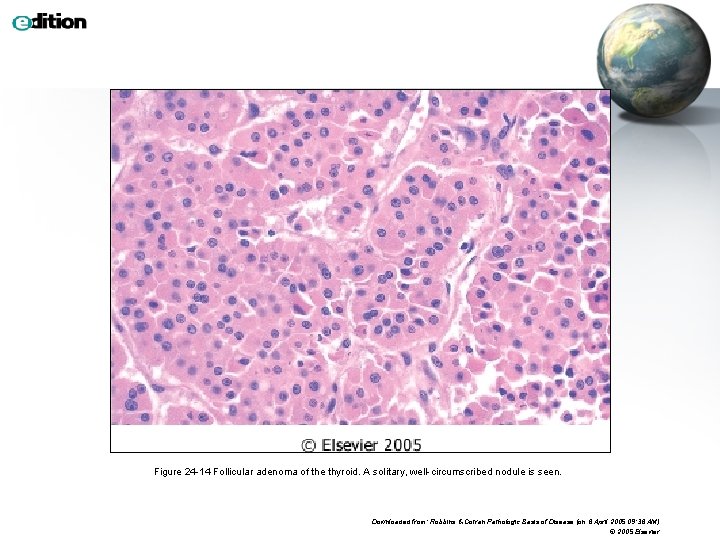 Figure 24 -14 Follicular adenoma of the thyroid. A solitary, well-circumscribed nodule is seen.