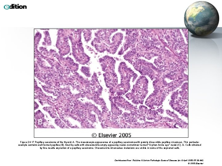 Figure 24 -17 Papillary carcinoma of the thyroid. A, The macroscopic appearance of a