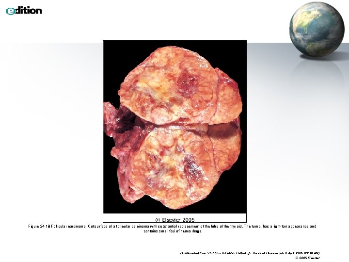 Figure 24 -18 Follicular carcinoma. Cut surface of a follicular carcinoma with substantial replacement