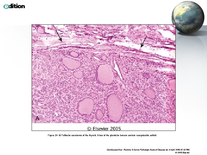 Figure 24 -19 Follicular carcinoma of the thyroid. A few of the glandular lumens