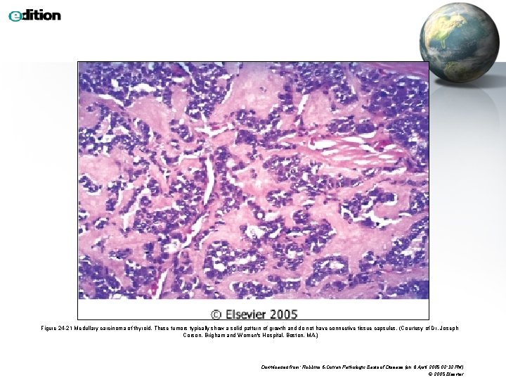 Figure 24 -21 Medullary carcinoma of thyroid. These tumors typically show a solid pattern