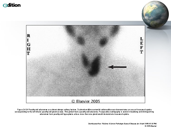 Figure 24 -24 Parathyroid adenomas are almost always solitary lesions. Technetium-99 m-sestamibi radionuclide scan