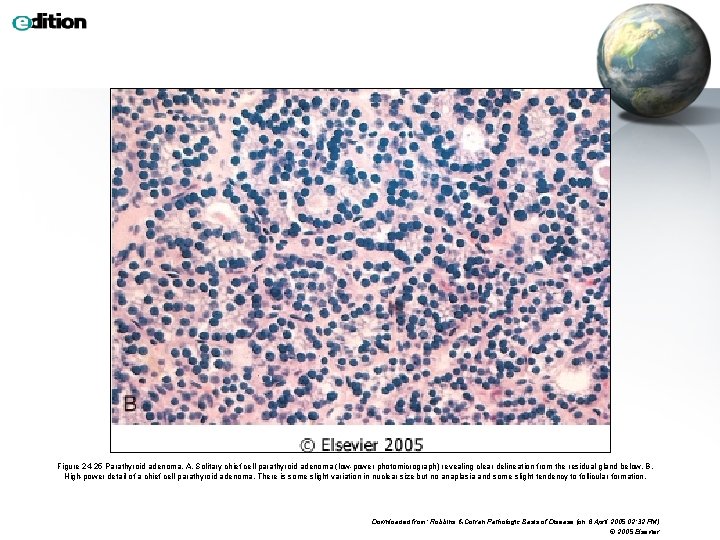Figure 24 -25 Parathyroid adenoma. A, Solitary chief cell parathyroid adenoma (low-power photomicrograph) revealing
