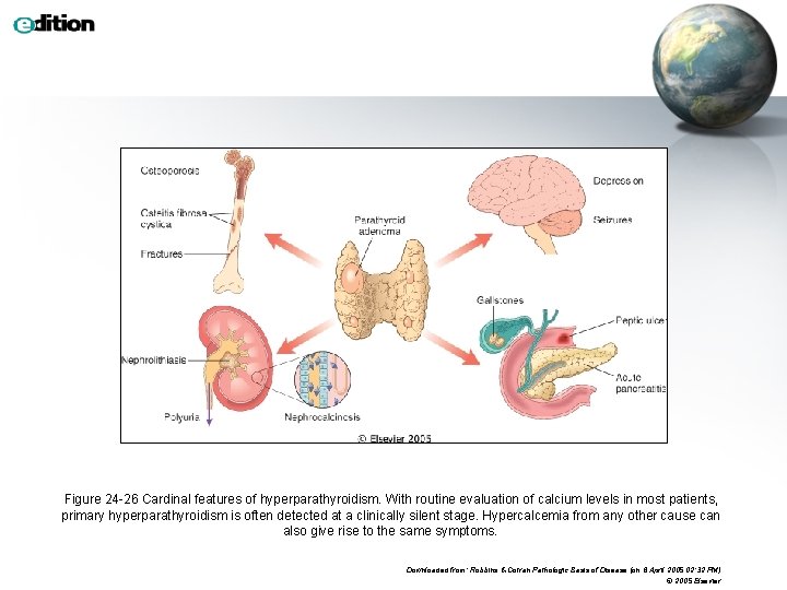 Figure 24 -26 Cardinal features of hyperparathyroidism. With routine evaluation of calcium levels in