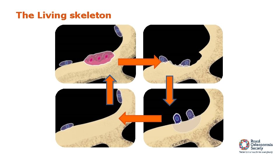 Skeleton Collapsing Managing Your Bone Health Karen Shanks Fracture Liaison