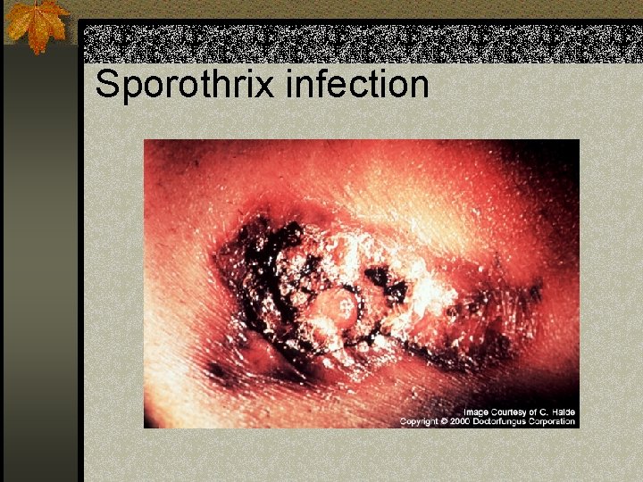 Sporothrix infection 