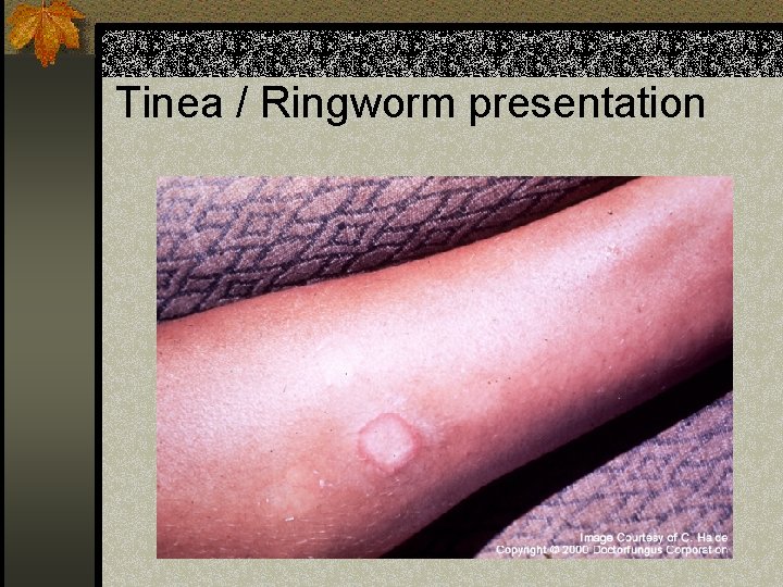 Tinea / Ringworm presentation 