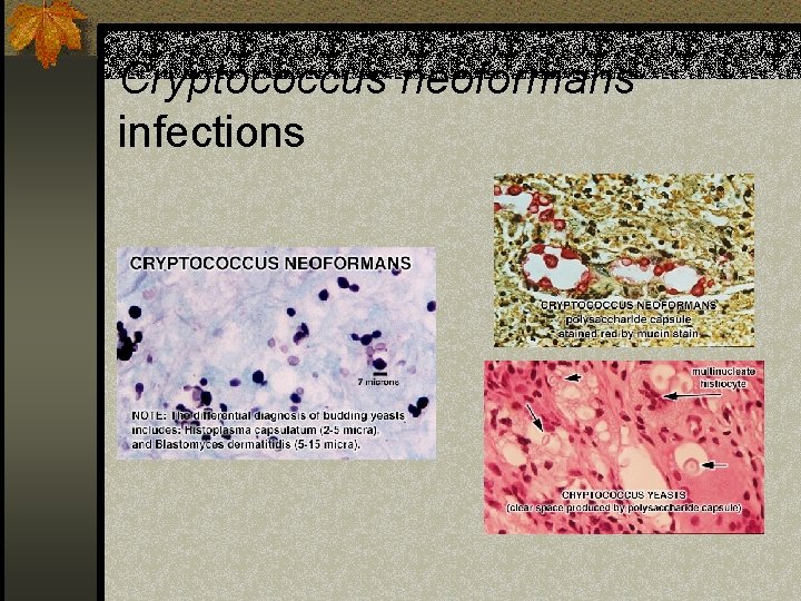 Cryptococcus neoformans infections 