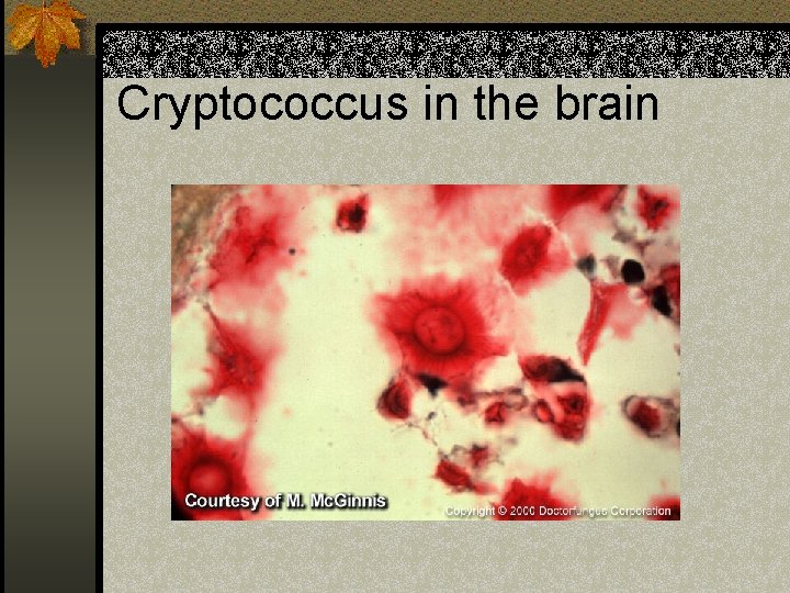 Cryptococcus in the brain 