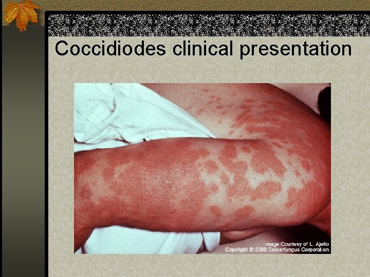 Coccidiodes clinical presentation 