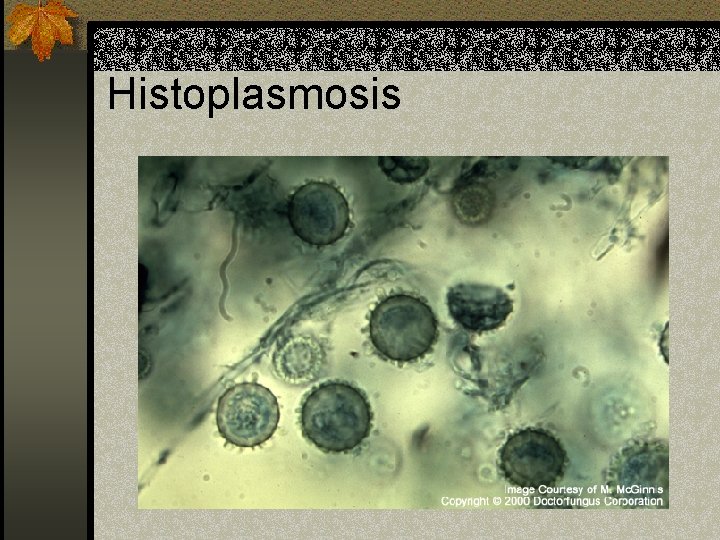 Histoplasmosis 