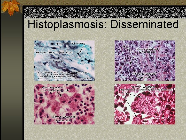 Histoplasmosis: Disseminated 