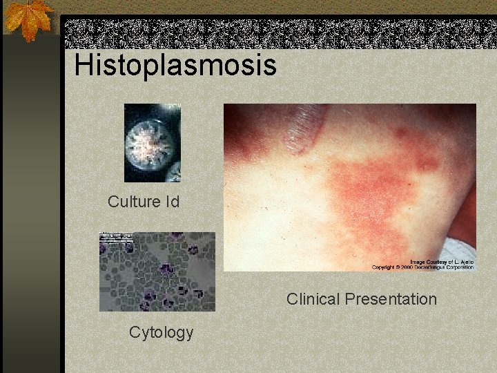 Histoplasmosis Culture Id Clinical Presentation Cytology 