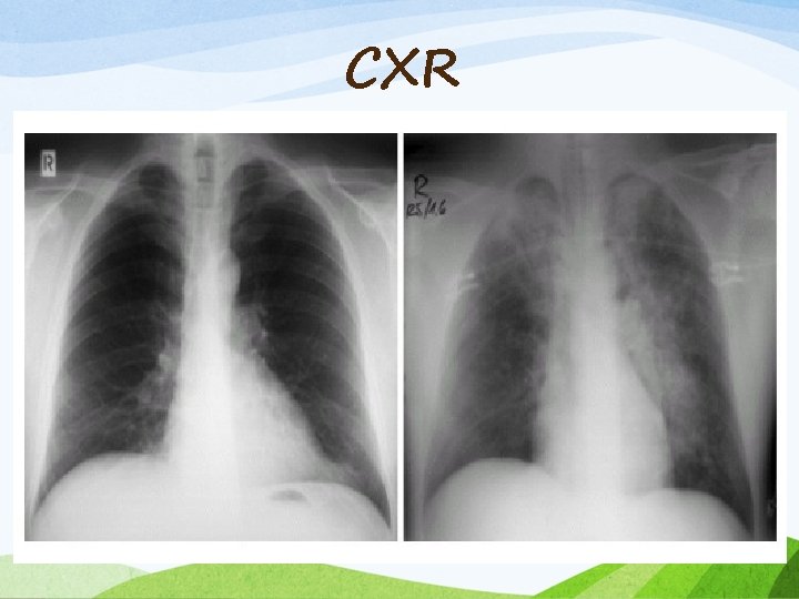 CXR 