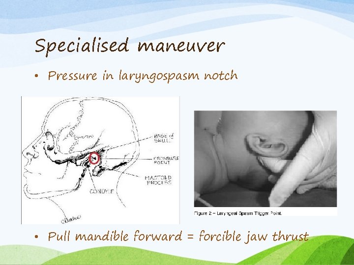 Specialised maneuver • Pressure in laryngospasm notch • Pull mandible forward = forcible jaw