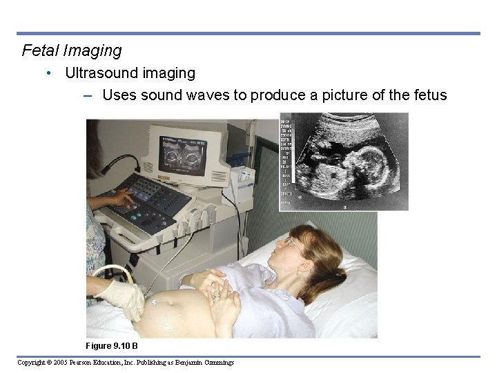 Fetal Imaging • Ultrasound imaging – Uses sound waves to produce a picture of