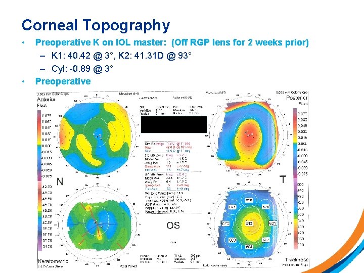 Corneal Topography • • Preoperative K on IOL master: (Off RGP lens for 2