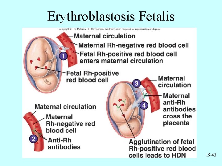 Erythroblastosis Fetalis 19 -43 