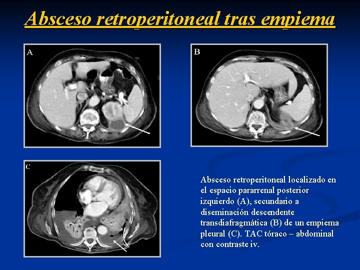 Absceso retroperitoneal tras empiema Absceso retroperitoneal localizado en el espacio pararrenal posterior izquierdo (A),