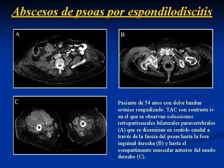 Abscesos de psoas por espondilodiscitis Paciente de 54 años con dolor lumbar crónico reagudizado.