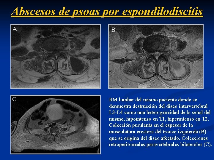 Abscesos de psoas por espondilodiscitis RM lumbar del mismo paciente donde se demuestra destrucción