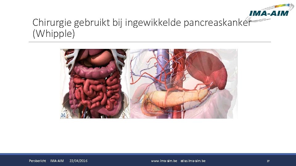 Chirurgie gebruikt bij ingewikkelde pancreaskanker (Whipple) Persbericht IMA-AIM 22/04/2016 www. ima-aim. be atlas. ima-aim.