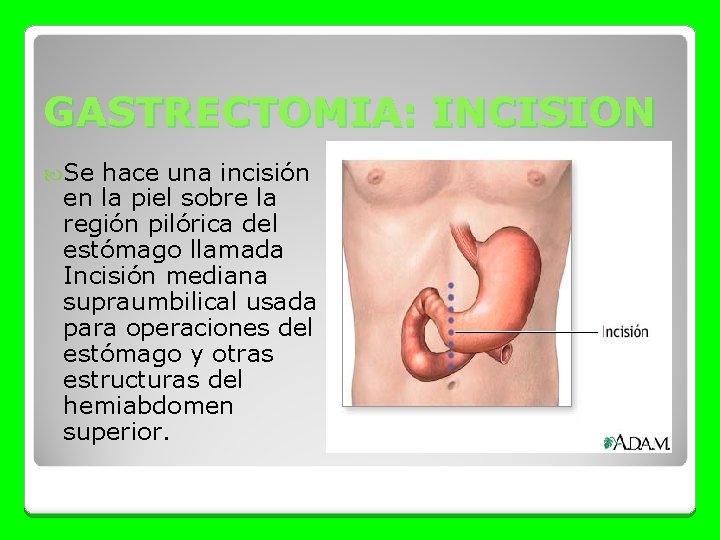 GASTRECTOMIA: INCISION Se hace una incisión en la piel sobre la región pilórica del