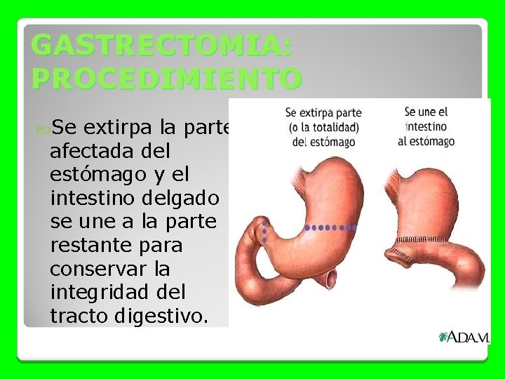 GASTRECTOMIA: PROCEDIMIENTO Se extirpa la parte afectada del estómago y el intestino delgado se