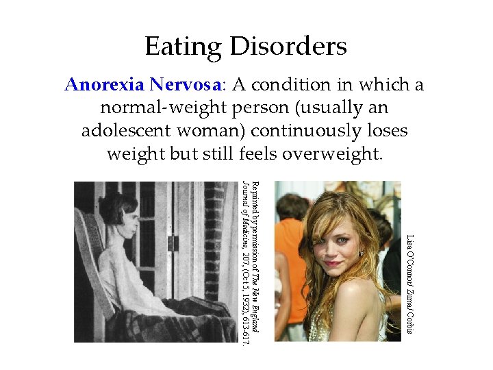 Eating Disorders Anorexia Nervosa: A condition in which a normal-weight person (usually an adolescent