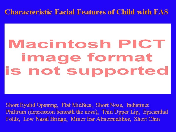 Characteristic Facial Features of Child with FAS Short Eyelid Opening, Flat Midface, Short Nose,