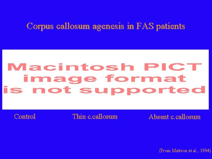 Corpus callosum agenesis in FAS patients Control Thin c. callosum Absent c. callosum (From