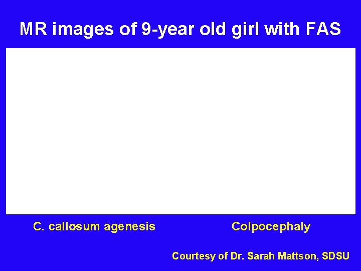 MR images of 9 -year old girl with FAS C. callosum agenesis Colpocephaly Courtesy