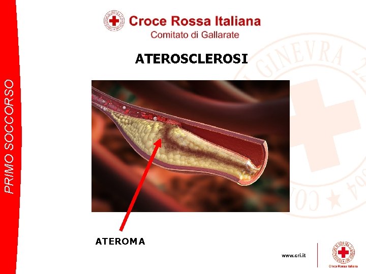 PRIMO SOCCORSO ATEROSCLEROSI ATEROMA 