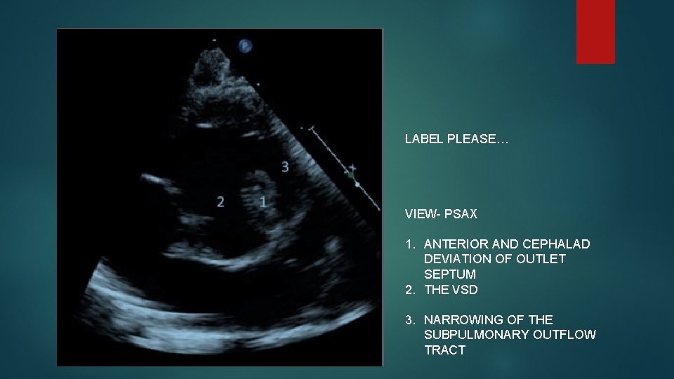 Psax Labels TETRALOGY OF FALLOT Spectrum of disease Archetype congenital
