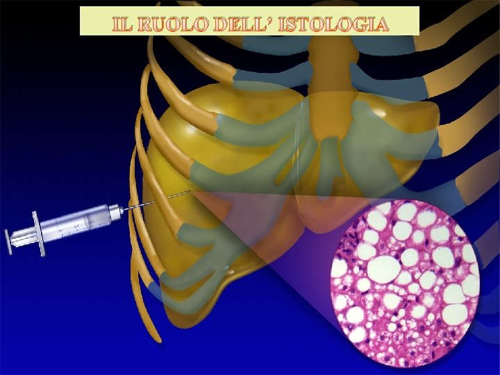 LIVER BIOPSY IL RUOLO DELL’ ISTOLOGIA 