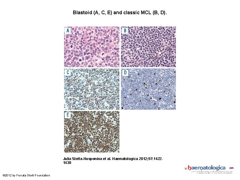 Blastoid (A, C, E) and classic MCL (B, D). Julia Slotta-Huspenina et al. Haematologica