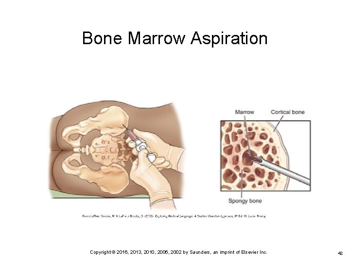 Bone Marrow Aspiration Copyright © 2016, 2013, 2010, 2006, 2002 by Saunders, an imprint