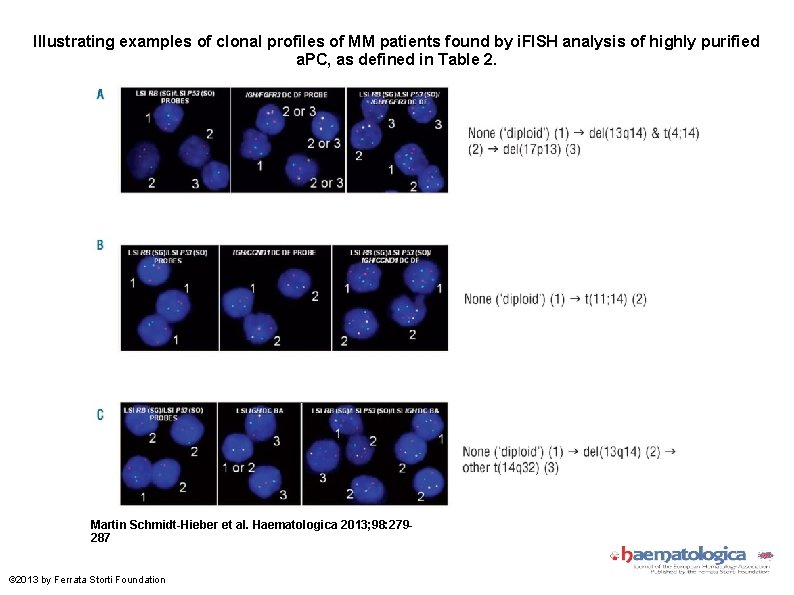 Illustrating examples of clonal profiles of MM patients found by i. FISH analysis of