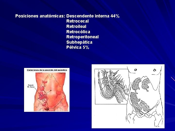 Posiciones anatómicas: Descendente interna 44% Retrocecal Retroileal Retrocólica Retroperitoneal Subhepàtica Pèlvica 5% 