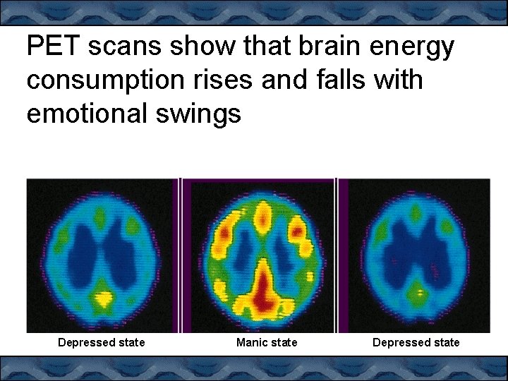 PET scans show that brain energy consumption rises and falls with emotional swings Depressed