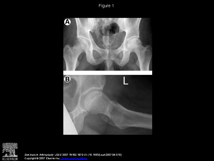 Figure 1 Seminars in Arthroplasty: JSES 2007 18192 -197 DOI: (10. 1053/j. sart. 2007.