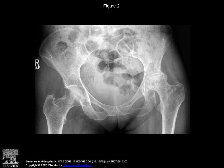 Figure 2 Seminars in Arthroplasty: JSES 2007 18192 -197 DOI: (10. 1053/j. sart. 2007.