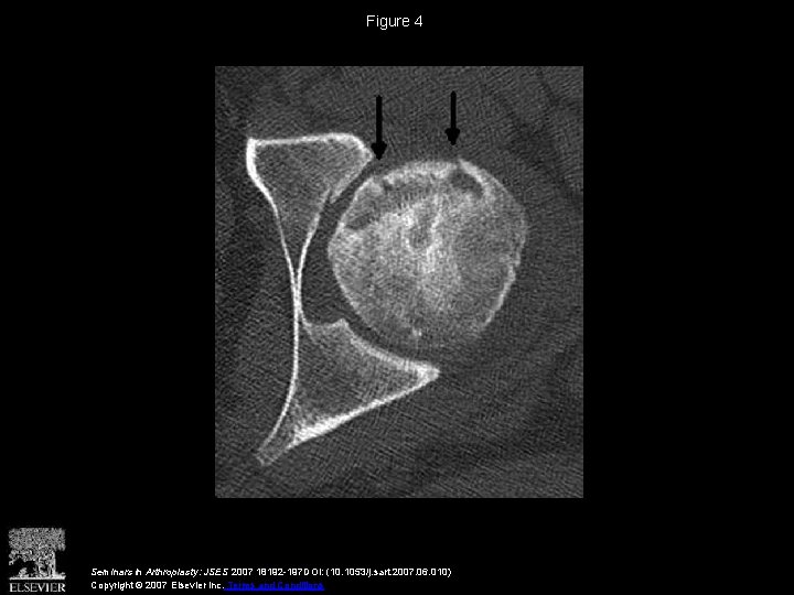 Figure 4 Seminars in Arthroplasty: JSES 2007 18192 -197 DOI: (10. 1053/j. sart. 2007.