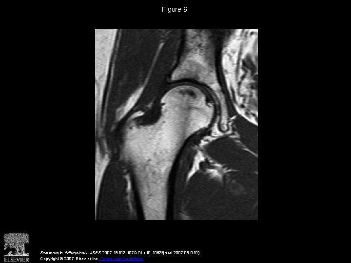 Figure 6 Seminars in Arthroplasty: JSES 2007 18192 -197 DOI: (10. 1053/j. sart. 2007.