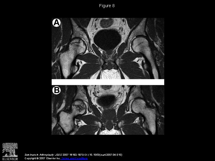 Figure 8 Seminars in Arthroplasty: JSES 2007 18192 -197 DOI: (10. 1053/j. sart. 2007.